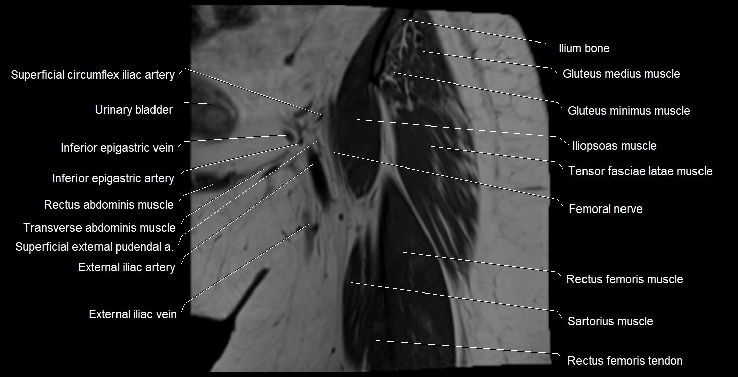 MRI Hip 3T coronal cross sectional anatomy image 7.webp